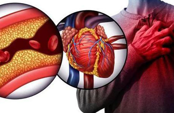 Cardiovascular Diseases