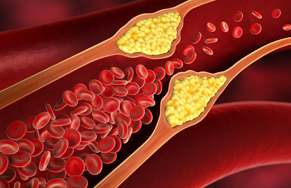 Dyslipidemia (Cholesterol)