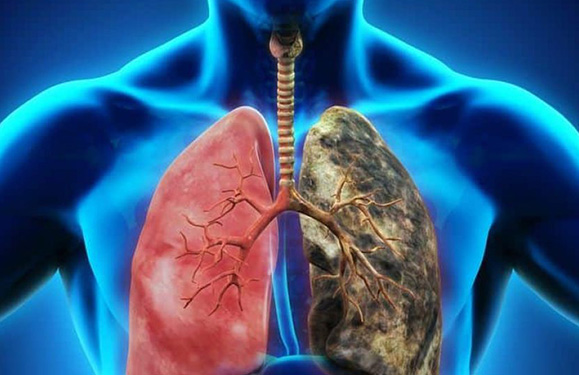 Respiratory Diseases